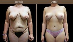 Before & After Tummy Tuck Surgery In New York City